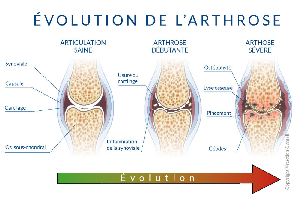 Schéma évolution arthrose